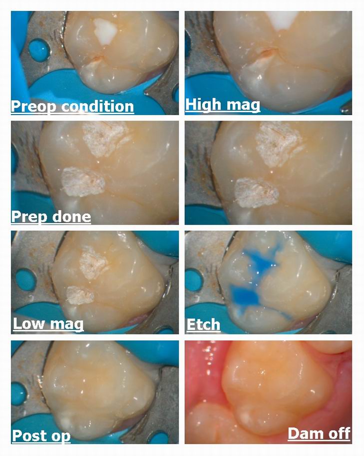 Class 1 microdental case 2.jpg